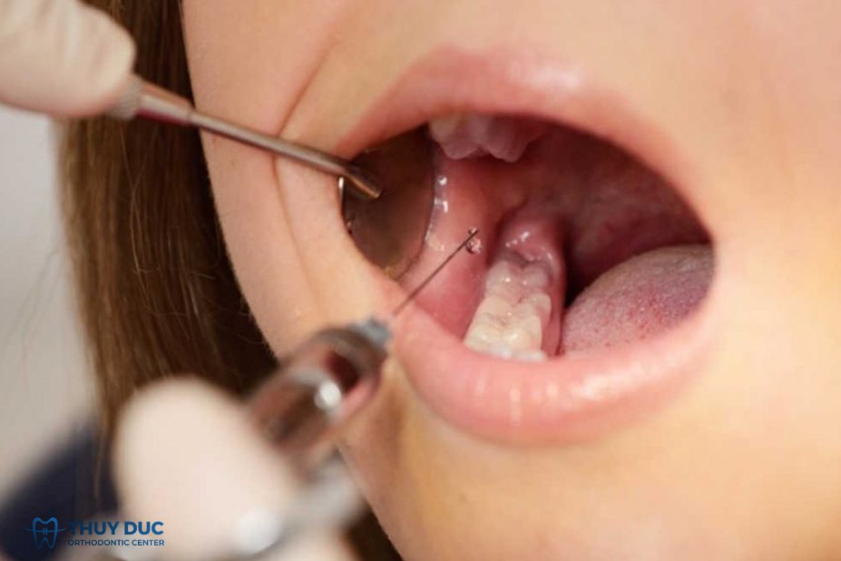 1. Thuốc tê là gì? 1 1. Thuốc tê là gì? 1