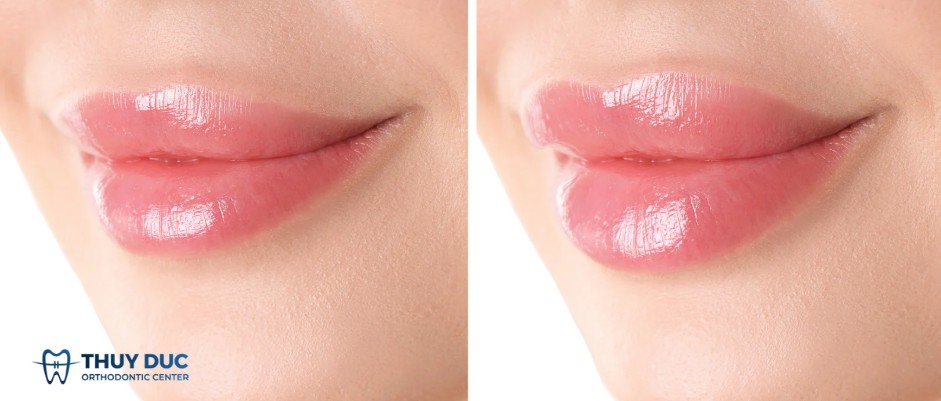 1.2. Hình dáng môi đẹp và các kiểu môi phổ biến 1