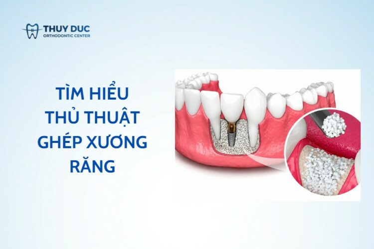 Ghép xương răng trong nha khoa – vật liệu và quy trình
