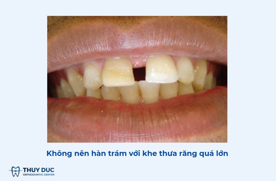 Những trường hợp răng thưa không nên hàn 1