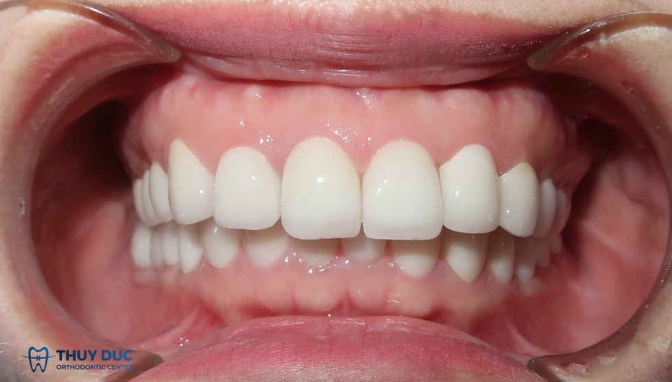 Làm răng toàn sứ giá bao nhiêu? 1 Làm răng toàn sứ giá bao nhiêu? 1