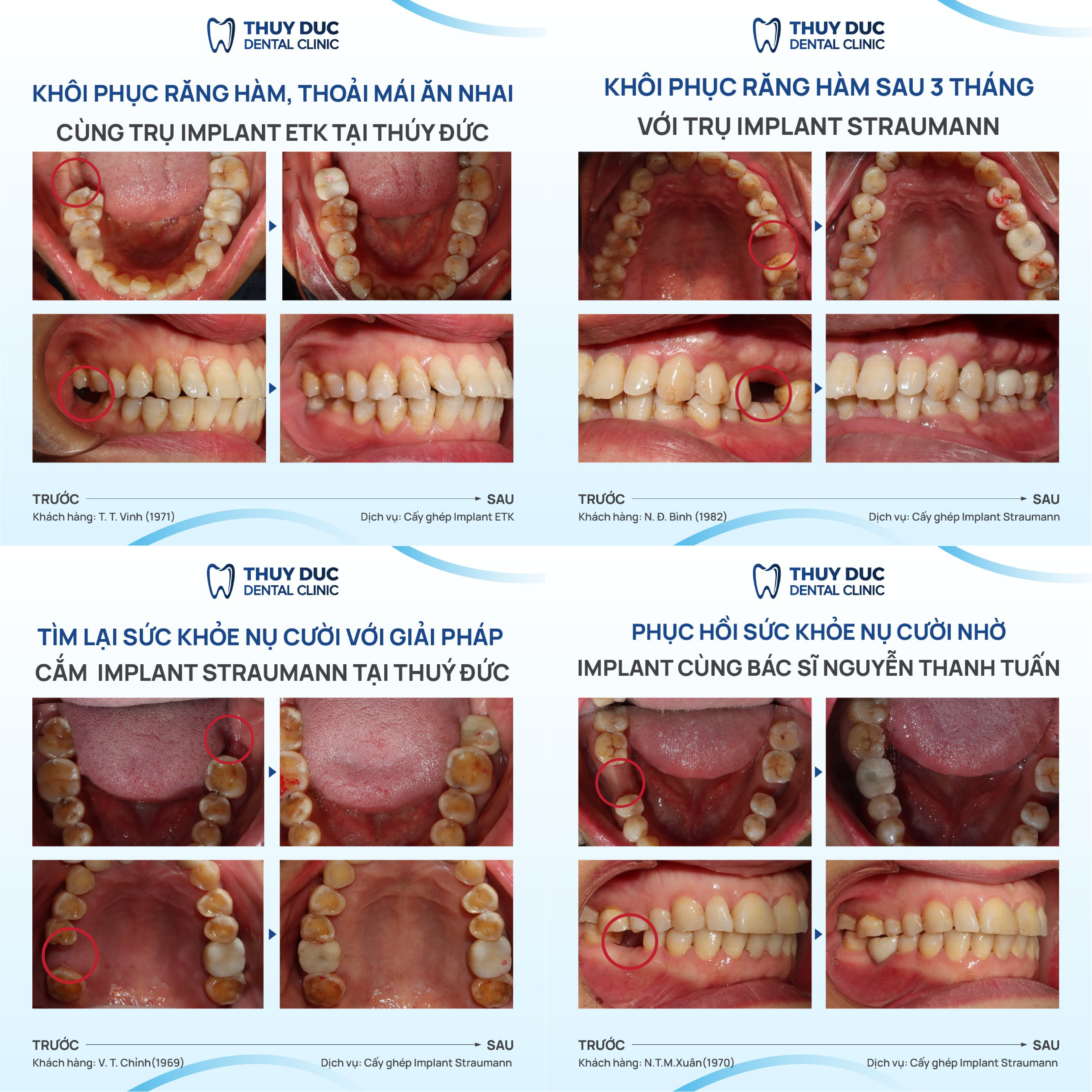 Một vài case cấy ghép Implant tại nha khoa Thúy Đức 2 Một vài case cấy ghép Implant tại nha khoa Thúy Đức 2