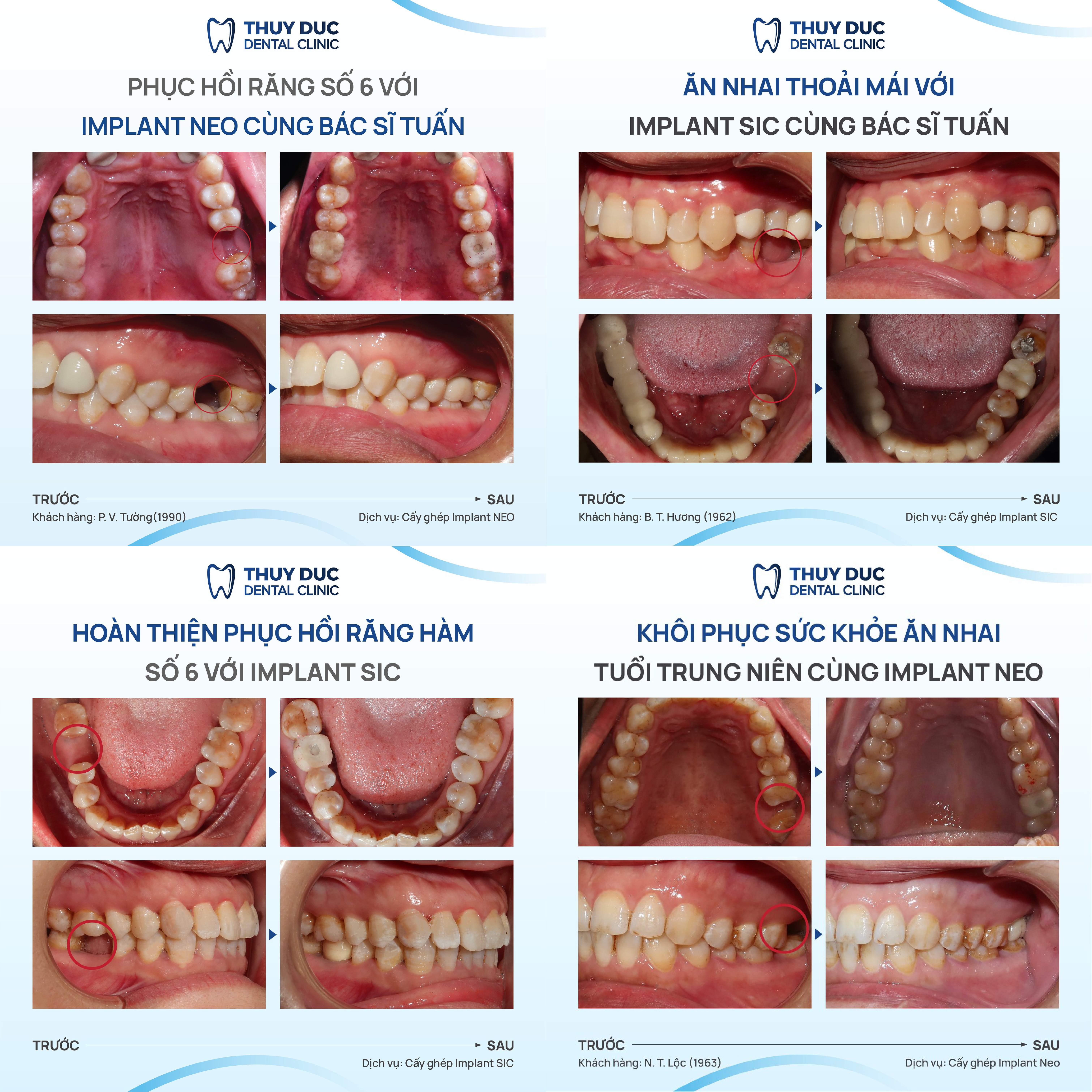 Một vài case cấy ghép Implant tại nha khoa Thúy Đức 3 Một vài case cấy ghép Implant tại nha khoa Thúy Đức 3