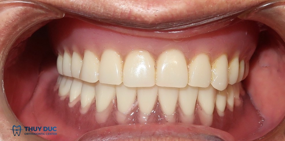 Phương pháp dùng hàm tháo lắp 1