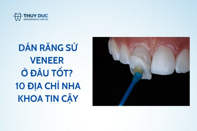 Dán răng sứ veneer ở đâu tốt? 10 địa chỉ nha khoa tin cậy