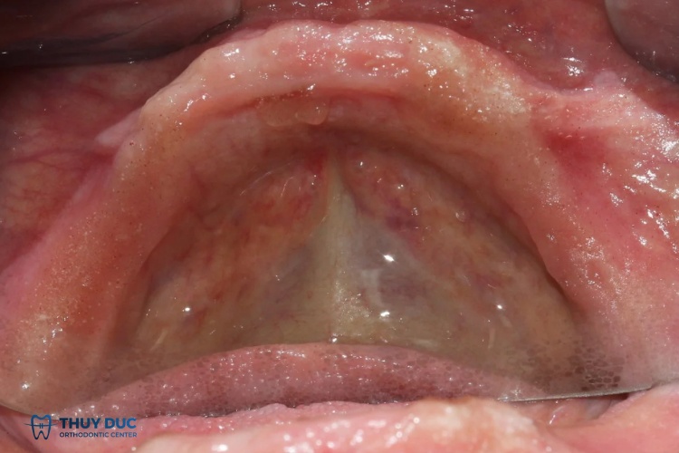 Mất răng toàn hàm