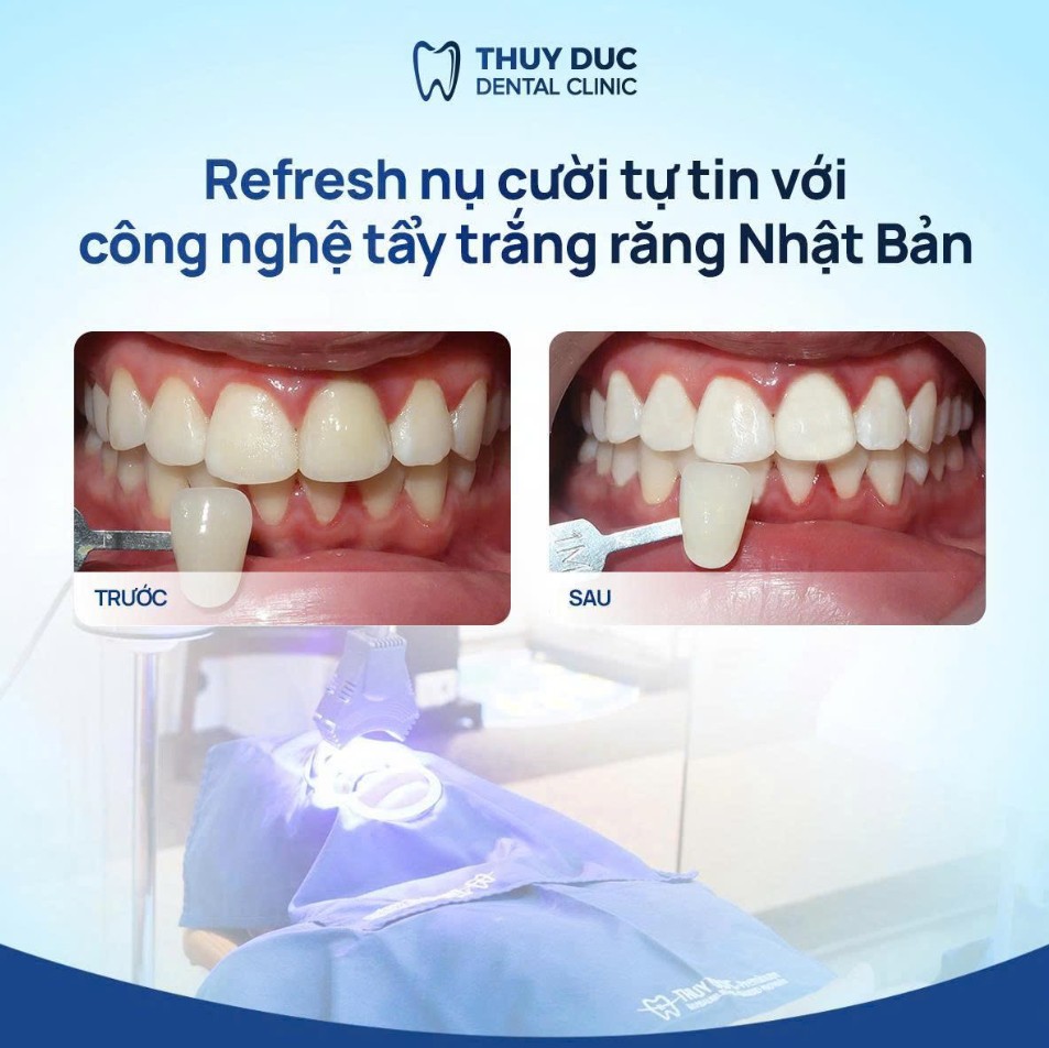 Review kết quả tẩy trắng răng tại Nha khoa Thúy Đức