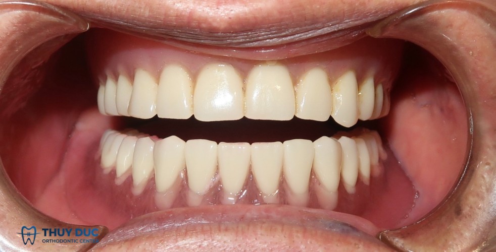 Hàm giả tháo lắp 2 Hàm giả tháo lắp 2