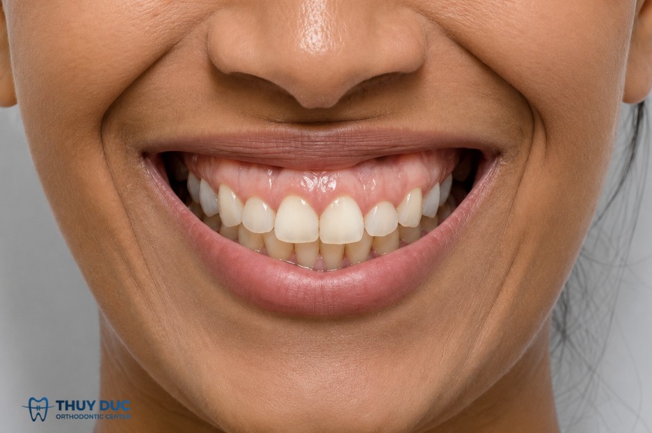 1. Cười hở lợi (gummy smile) 1 1. Cười hở lợi (gummy smile) 1