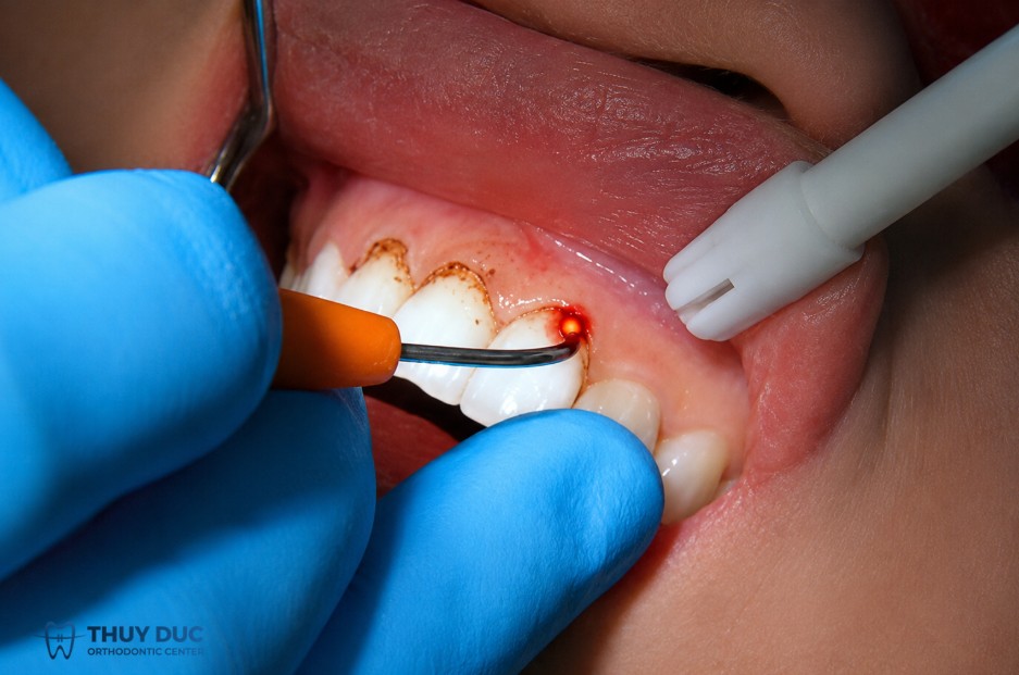 1. Cắt lợi bằng laser là gì? 1 1. Cắt lợi bằng laser là gì? 1