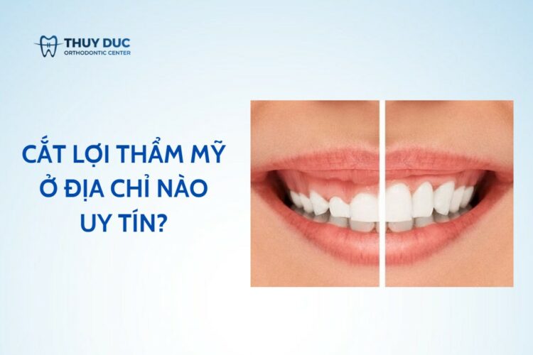 Cắt lợi thẩm mỹ ở đâu – gợi ý 10 địa chỉ tin cậy