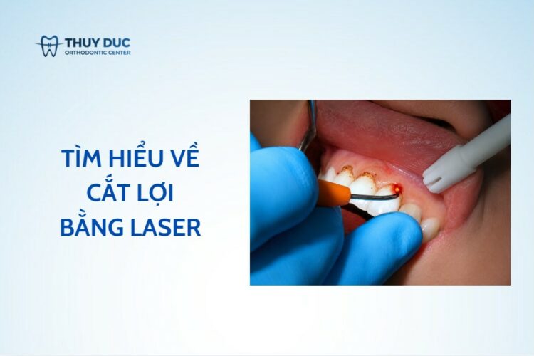 Cắt lợi bằng laser là gì? Chi phí cắt lơi laser bao nhiêu?