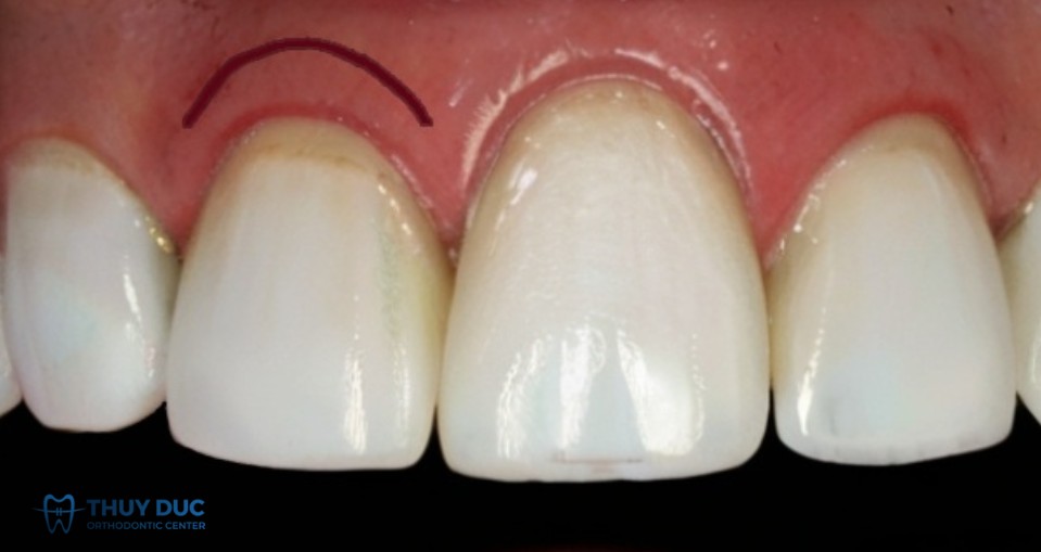 2. Cắt lợi có nguy hiểm không? 1