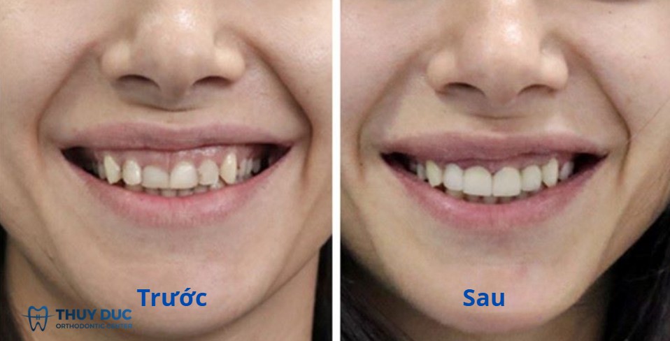 3. Quy trình cắt lợi diễn ra như thế nào? 1