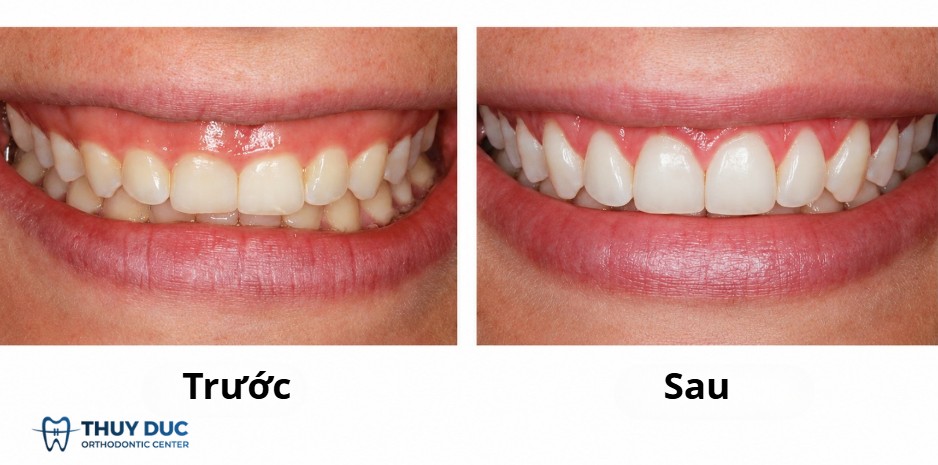 7. So sánh cắt lợi đơn thuần và cắt lợi mài xương 1 7. So sánh cắt lợi đơn thuần và cắt lợi mài xương 1