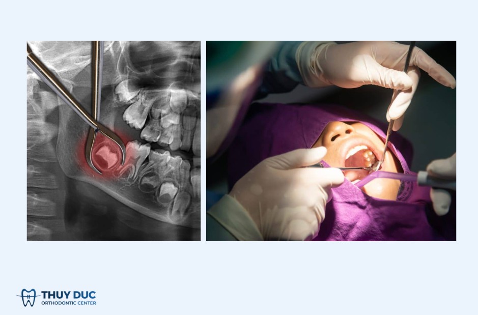 Những trường hợp bác sĩ có thể chỉ định kháng sinh 1 Những trường hợp bác sĩ có thể chỉ định kháng sinh 1