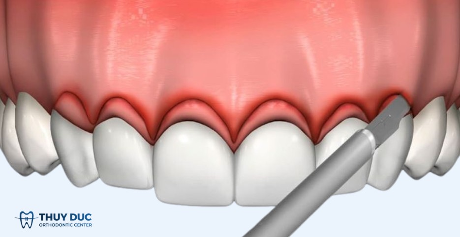3.5. Tạo hình lợi và khâu lại 1 3.5. Tạo hình lợi và khâu lại 1