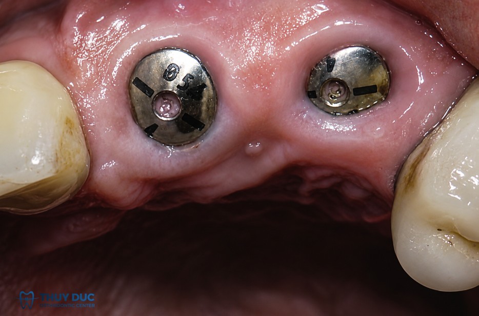 Gắn Healing Abutment có đau không? 1 Gắn Healing Abutment có đau không? 1