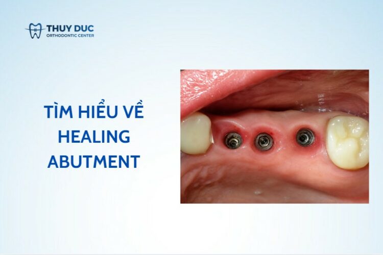 Healing trong implant là gì, được dùng làm gì trong nha khoa?