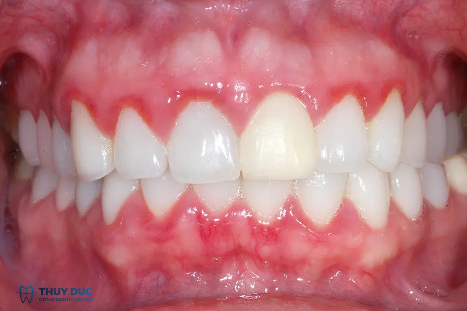 Người bị viêm lợi có niềng răng được không? 1