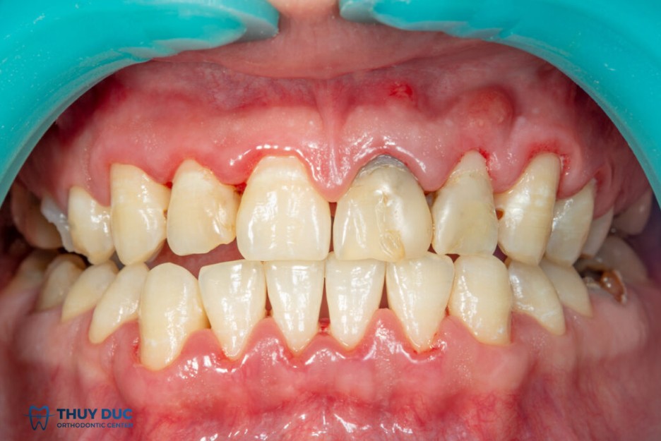 Người bị viêm lợi có niềng răng được không? 2