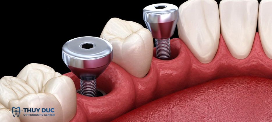 1.3. Bốn chức năng cụ thể của Healing Abutment 1 1.3. Bốn chức năng cụ thể của Healing Abutment 1