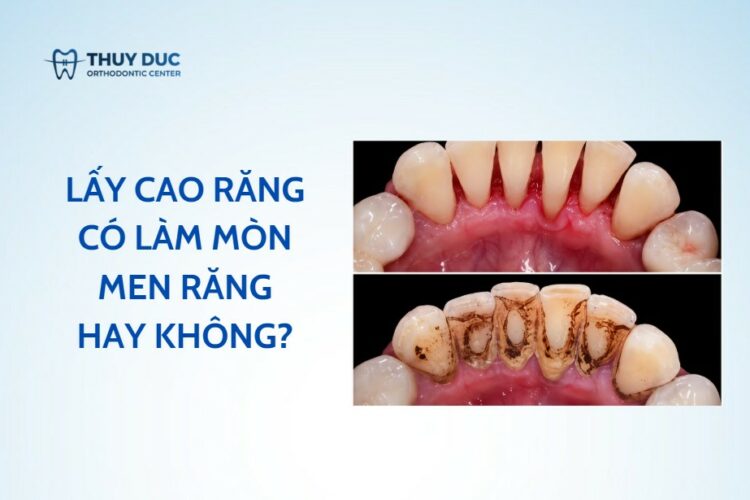 Lấy cao răng có làm mòn men răng không?