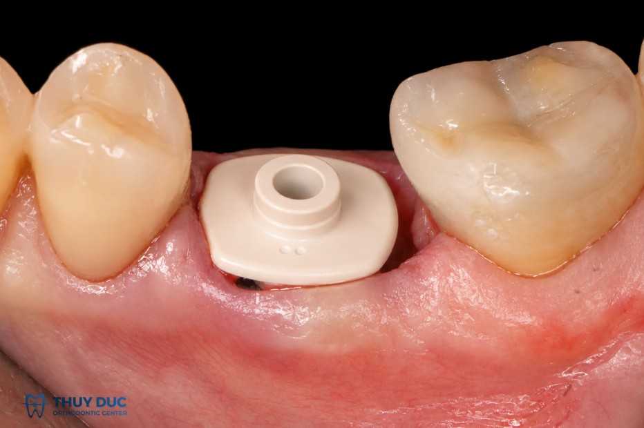 3.1. Hai thời điểm có thể đặt Healing Abutment 1 3.1. Hai thời điểm có thể đặt Healing Abutment 1