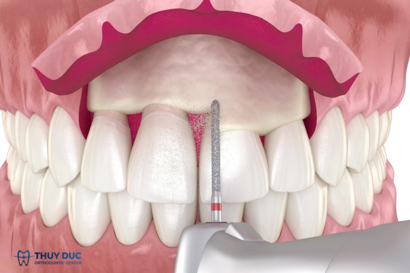 1. Cắt lợi mài xương ổ răng là gì? 1 1. Cắt lợi mài xương ổ răng là gì? 1