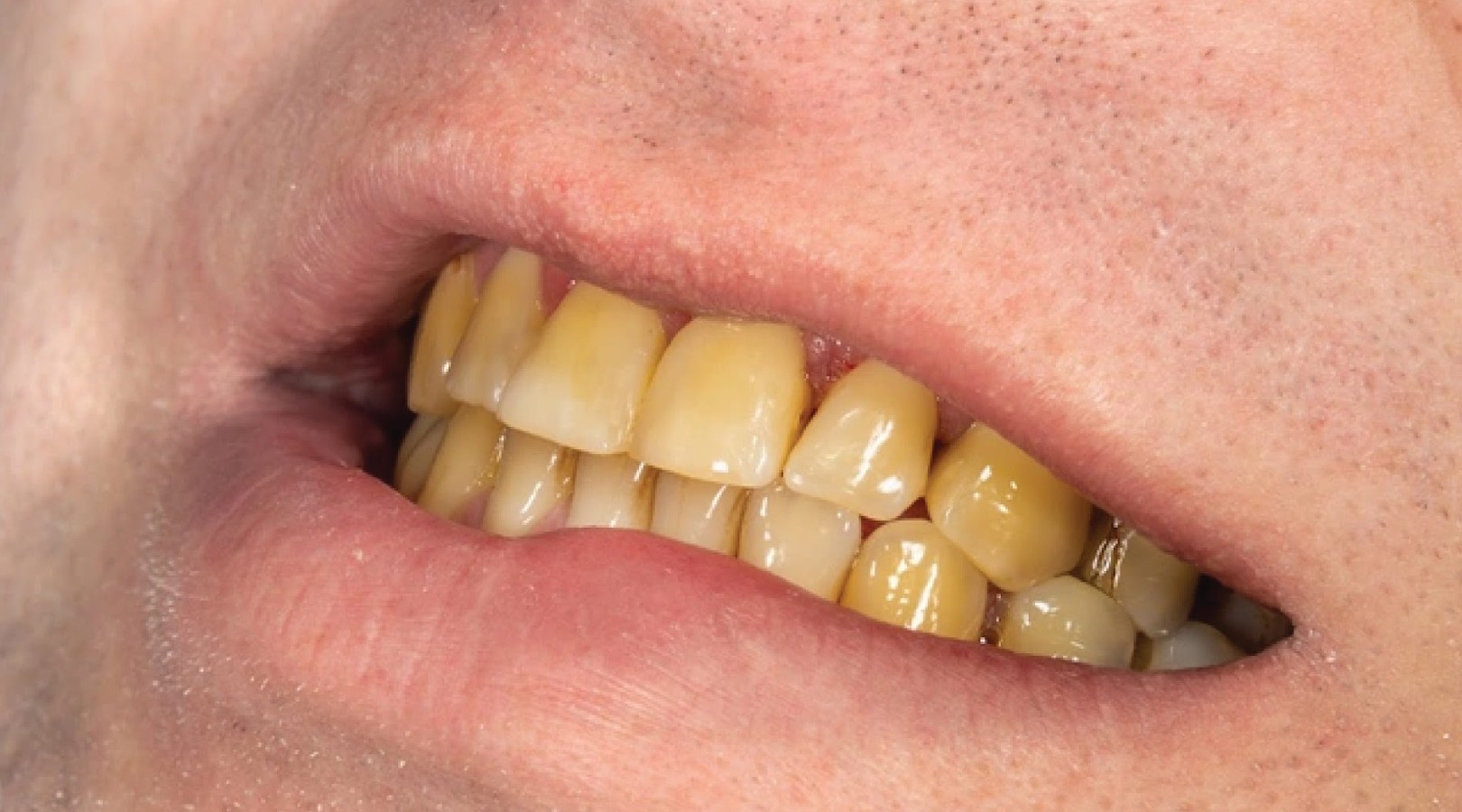 Răng nhiễm Tetracycline