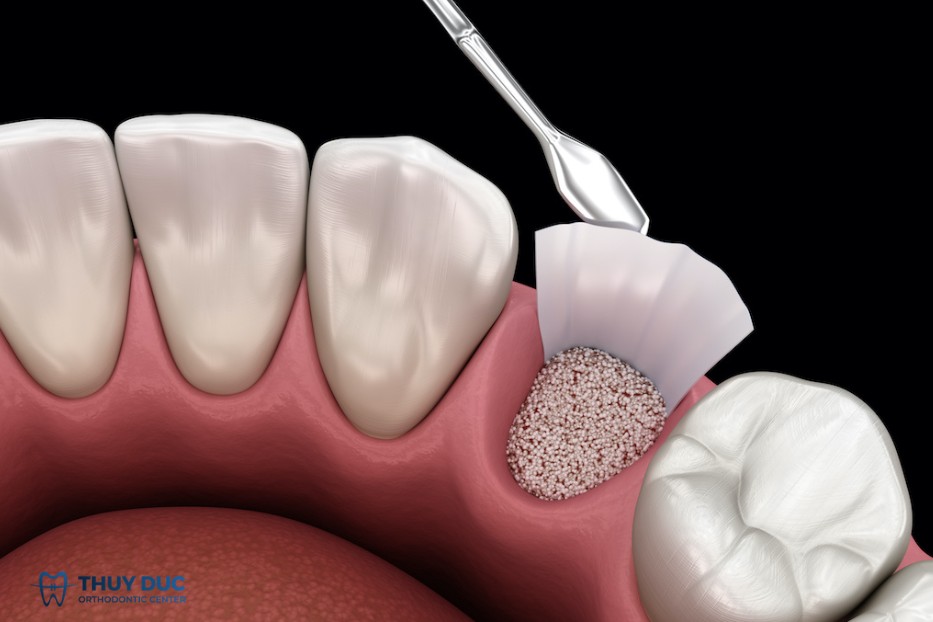 3. Trường hợp nào bắt buộc phải ghép xương? 1 3. Trường hợp nào bắt buộc phải ghép xương? 1