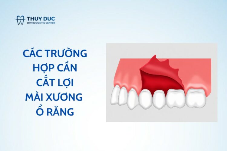 Cắt lợi mài xương ổ răng – trường hợp nào cần áp dụng?