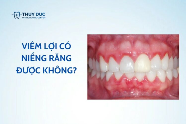Viêm lợi có niềng răng được không?