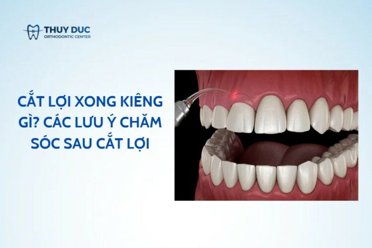 Cắt lợi xong kiêng gì? Các lưu ý chăm sóc sau cắt lợi