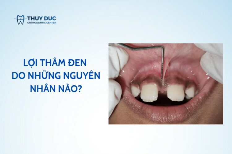 Lợi thâm đen – do những nguyên nhân nào, có chữa được không?