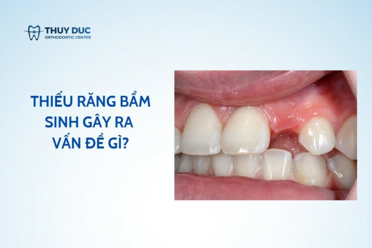 Thiếu răng bẩm sinh gây ra vấn đề gì, giải pháp tối ưu?