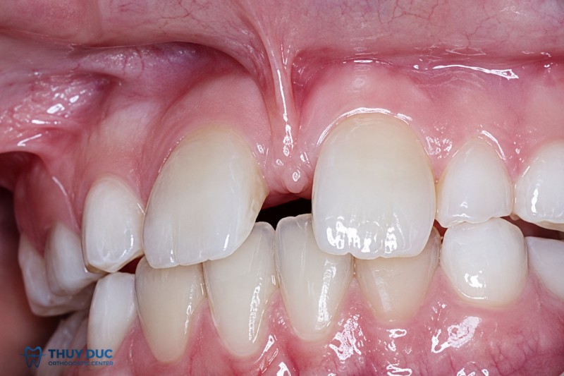 1. Phanh môi là gì? Cấu trúc bình thường như thế nào? 1