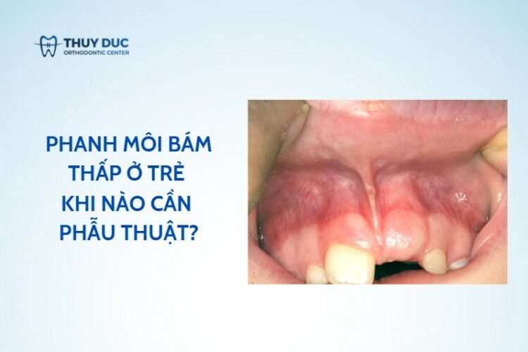 Phanh môi bám thấp ở trẻ – khi nào cần phẫu thuật?