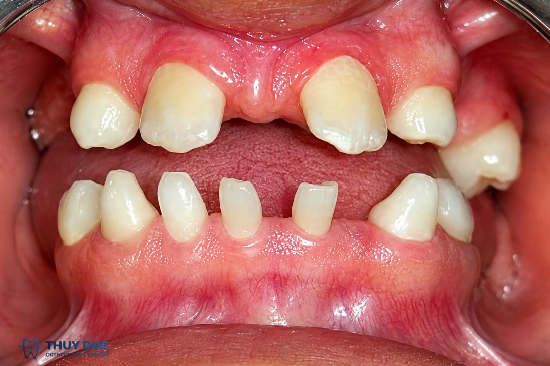 1. Thiếu răng bẩm sinh là gì? Khác gì với mất răng thông thường? 1 1. Thiếu răng bẩm sinh là gì? Khác gì với mất răng thông thường? 1