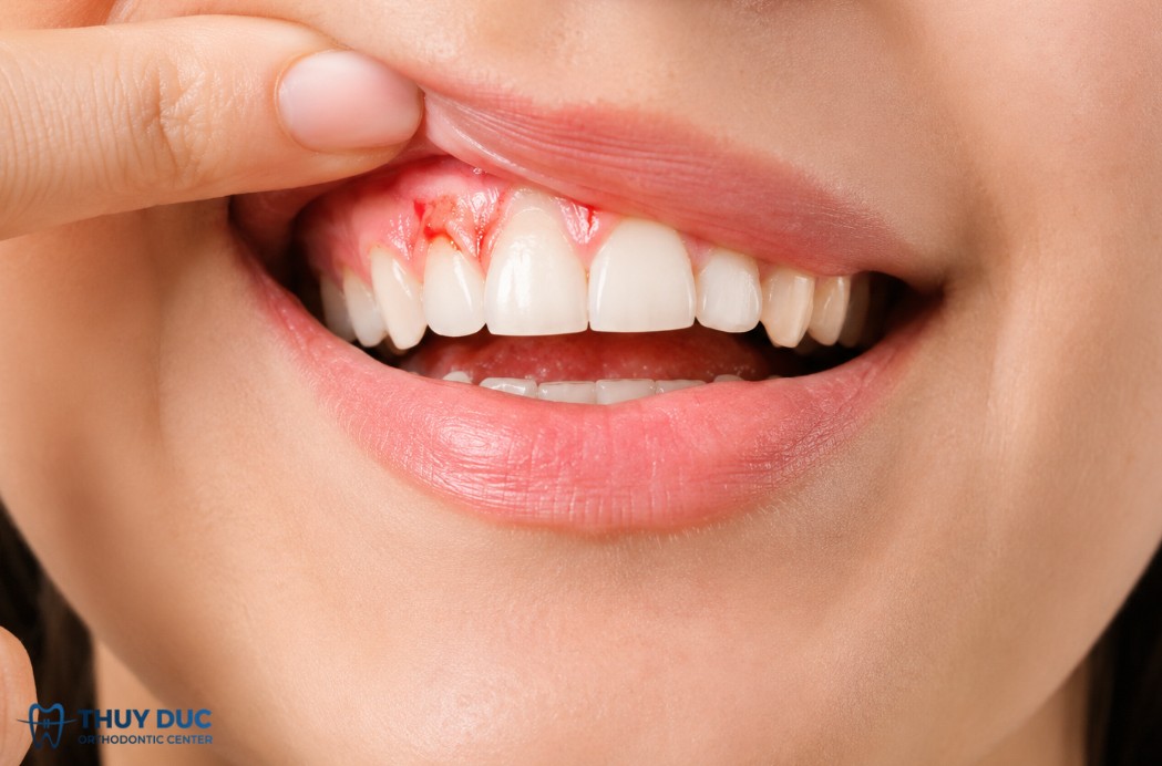 Chảy máu nướu thường xuyên, không rõ nguyên nhân 1 Chảy máu nướu thường xuyên, không rõ nguyên nhân 1