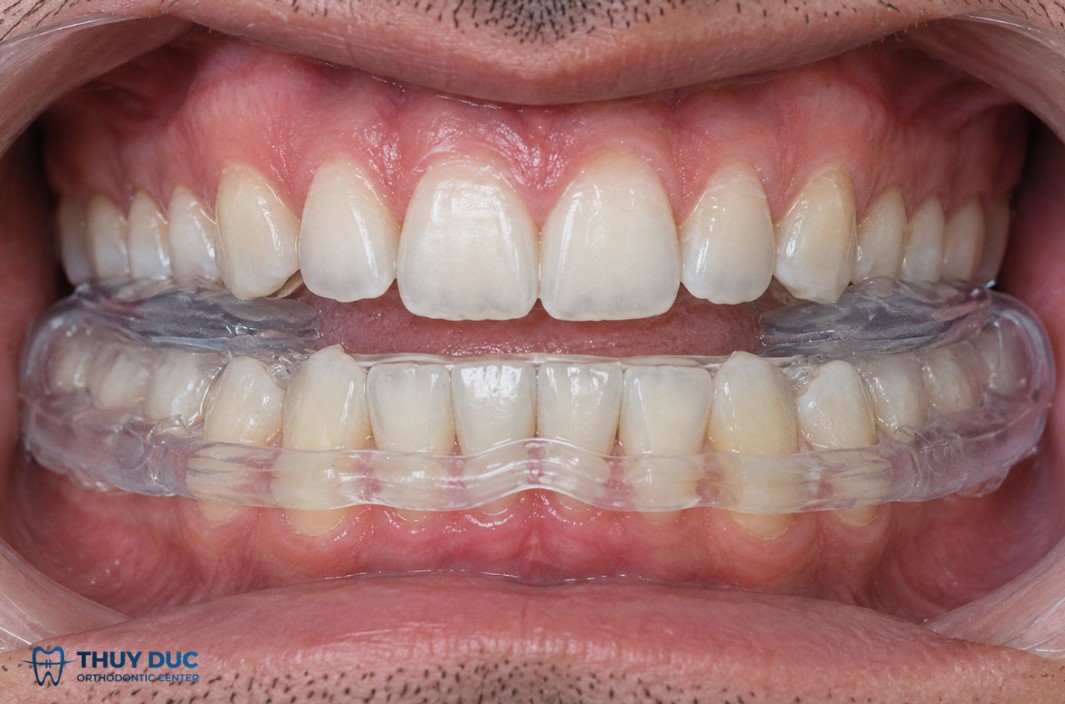 Máng chống nghiến 1 Máng chống nghiến 1