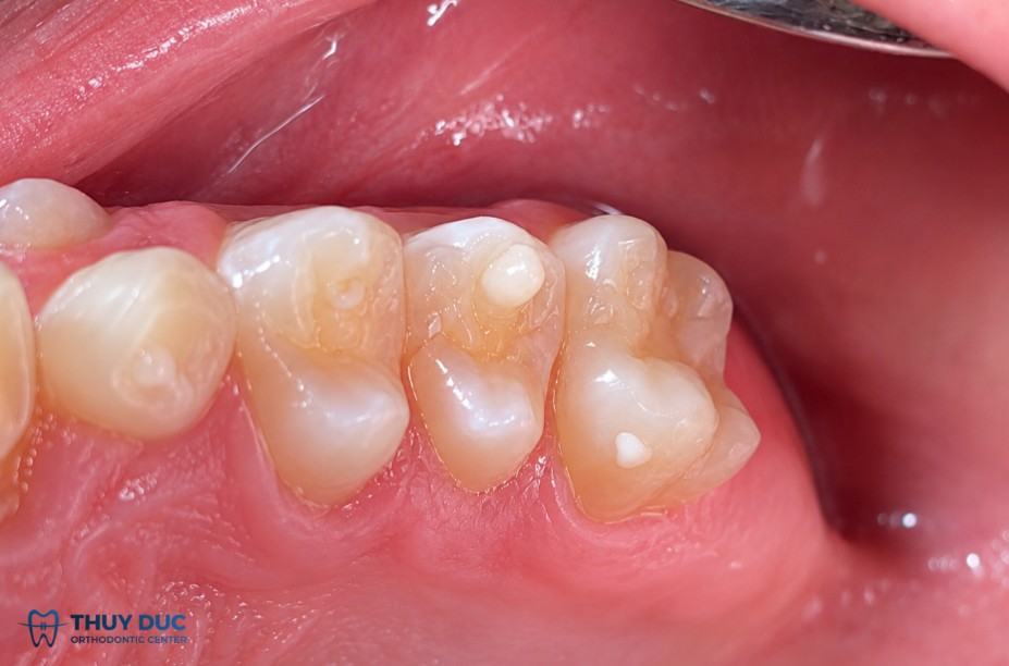 Răng cối nhỏ hàm dưới là vị trí thường gặp nhất 1