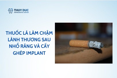 Thuốc lá làm chậm lành thương sau nhổ răng và cấy ghép implant ra sao?