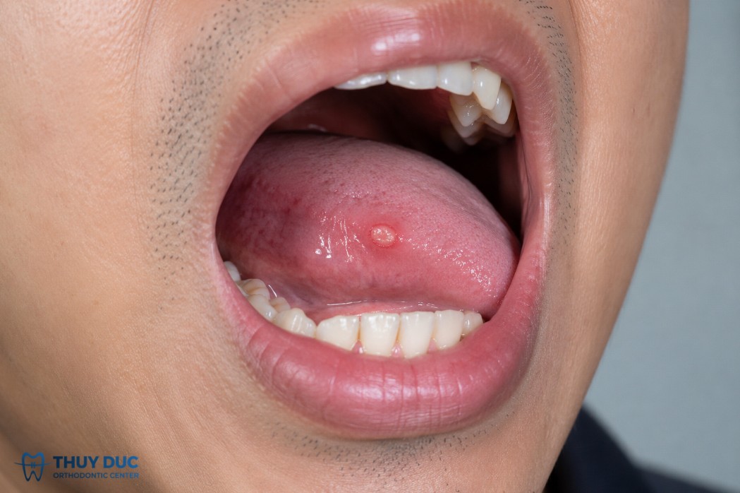 Vết loét miệng không lành sau 2 tuần 1 Vết loét miệng không lành sau 2 tuần 1