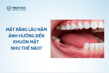 Mất răng lâu năm ảnh hưởng đến khuôn mặt như thế nào?