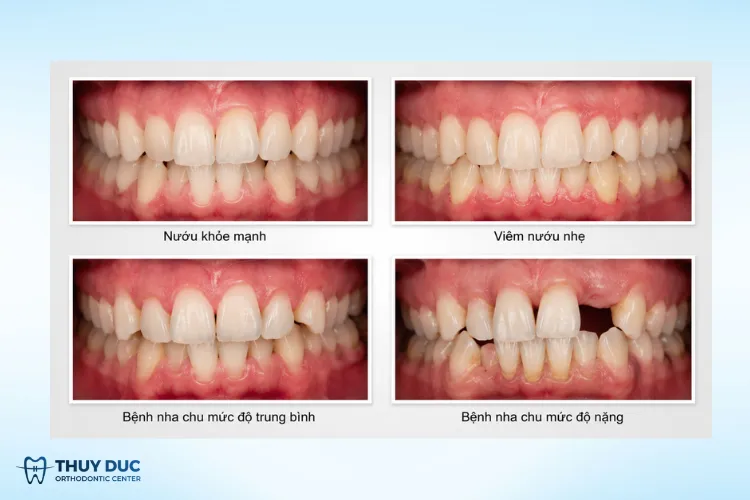 Mức độ phổ biến của cả hai bệnh lý, vì sao mối liên hệ này quan trọng 1 Mức độ phổ biến của cả hai bệnh lý, vì sao mối liên hệ này quan trọng 1