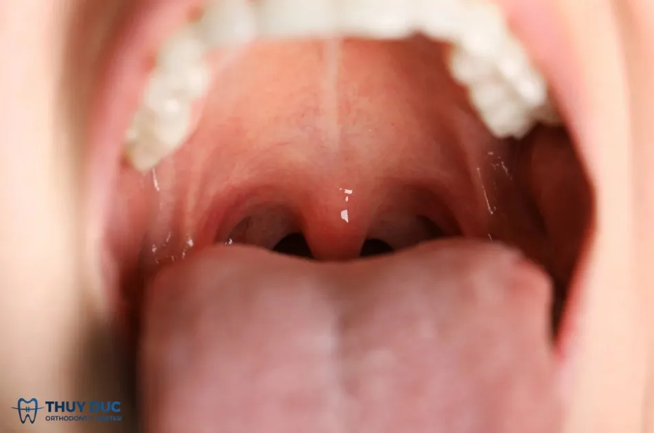Vai trò của nước bọt trong khoang miệng 1 Vai trò của nước bọt trong khoang miệng 1