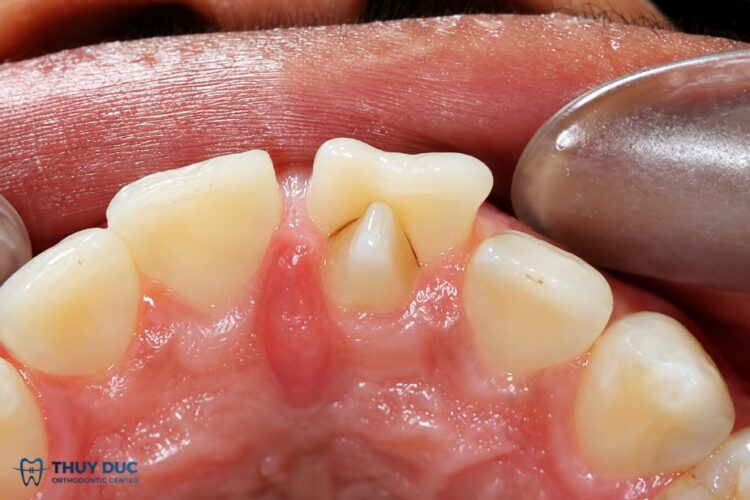 Răng có múi phụ – có gây ảnh hưởng gì không?