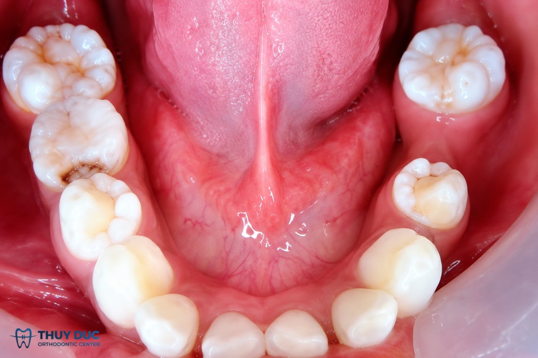 Răng dâu tằm là gì? 1 Răng dâu tằm là gì? 1