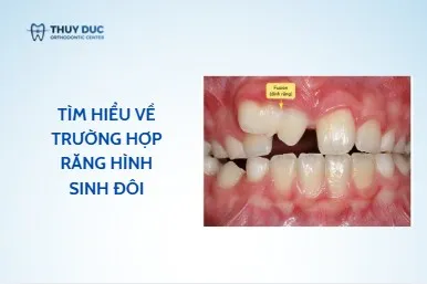 Răng hình sinh đôi là gì?
